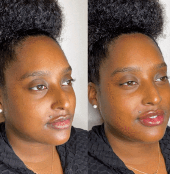 lip filler treatment 3