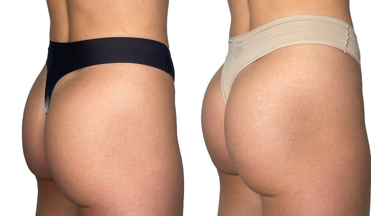 Radiesse-buttlift-bbl-phoenix-2