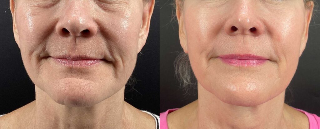 Morpheus8-before-after-1