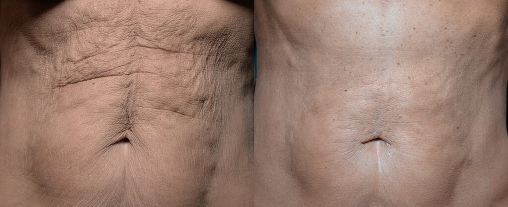 Morpheus8-before-after-4