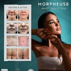 morpheus8New